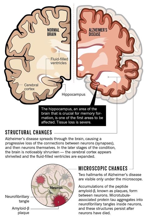 An age-old story of dementia Alzheimers Brain Image, Alzheimers Disease Brain, Alzheimer’s Disease, Brain Atrophy, Brain Notes, What Is Intelligence, Alzheimers Disease, Medical Assistant Student, Neurological System