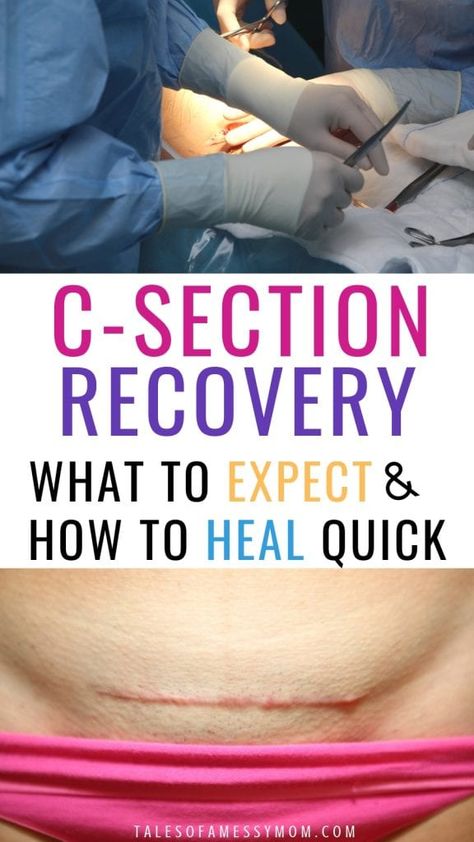 C-section recovery tips and what to put in your c-section recovery kit. The best postpartum recovery tips for what to expect and healing fast after a c-section. Cesarean section recovery cases and tips for mom. #csectionrecovery #postpartumrecovery #cesarean #csection #postpartum C Section Recovery Timeline, Healing From C Section, Mother Tips, C Section Scars, Emergency C Section, C Section Recovery, Body After Baby, Cesarean Section, Mommy Things