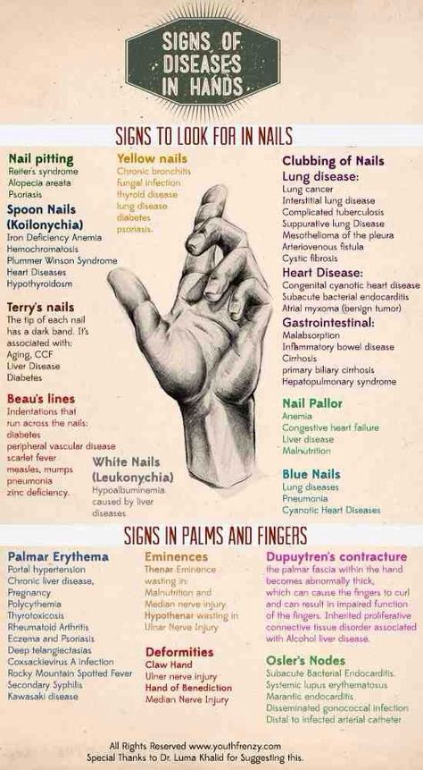 blue-lights-and-tea:  Clues to help you in making a diagnosis.  This is handy! Palms Hands, Hands Nails, Medical Facts, Medical Examination, Nursing Tips, Nursing Study, Nursing Education, Nursing Notes, Medical Knowledge