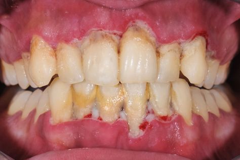 Reverse Cavities, Sensitive Teeth Remedy, Discolored Teeth, Pasta Dental, Dental Bridge, Teeth Health, Receding Gums, Periodontal Disease, Dental Hygienist