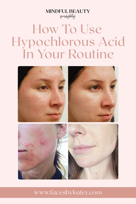 One recent rising star in the skincare realm is hypochlorous acid. This powerful yet gentle compound is making waves for its numerous uses for the skin and conditions such as acne and eczema. Learn how to use this in your skincare routine! Skin Care For Normal To Dry Skin, Hypochlorous Acid, Hydrochloric Acid, Dry Flaky Skin, Acne Serum, Skin Care Order, Flaky Skin, Making Waves, Skincare Routine