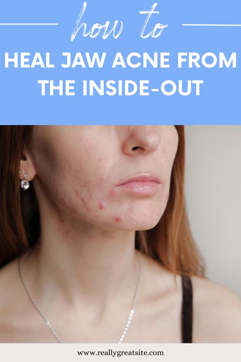 How to Heal Jaw Acne from the Inside-Out Jaw Acne Causes, Jaw Line Acne, Jawline Acne Causes, Jawline Acne How To Get Rid Of, Jawline Acne, Neck Acne, Heal Open Acne Wound, Acne Reasons, Pregnancy Acne