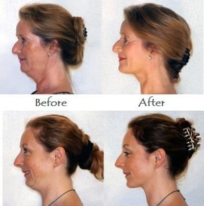 Naturally Lessen A Dual Chin: Keeping Your Face Fit And Lifted With Facial Rejuvenation Routines Saggy Cheeks, Defined Jawline, Face Lift Exercises, Beachbody Workout, Double Chin Removal, Double Chin Exercises, Toning Exercises, Chin Exercises, Face Fat