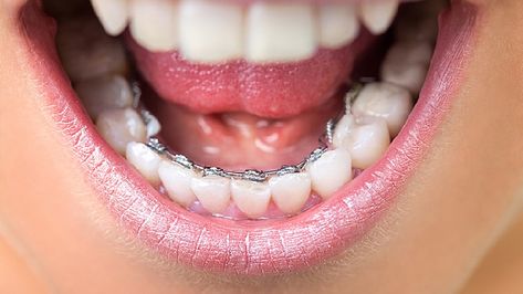 There are so many options available to those who want to get their teeth straightened today, including lingual braces. But what are lingual braces? Invisible Teeth Braces, Lingual Braces, Braces Cost, Types Of Braces, Invisalign Braces, Misaligned Teeth, Invisible Braces, Clear Braces, Braces Colors