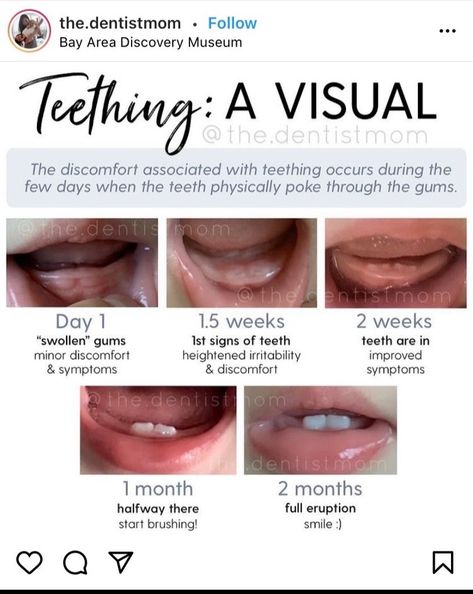 No teeth yet... are these teeth about to come through? - August 2020 Babies | Forums | What to Expect Teething Symptoms Baby, Teething Signs, Body Rash, Teething Symptoms, Teething Gums, No Teeth, Swollen Gum, Smart Parenting, Silicone Brush