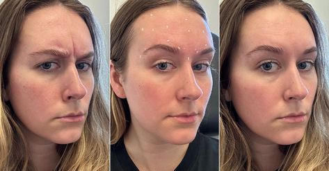 I'm 29 and Just Tried Botox—5 Things I Wish I Knew Before My Appointment Botox For Beginners, Before And After Botox Pictures, Botox Before After, Botox Results, Small Forehead, Botox Before And After, Muscle Atrophy, Neck Cream, Eye Drops