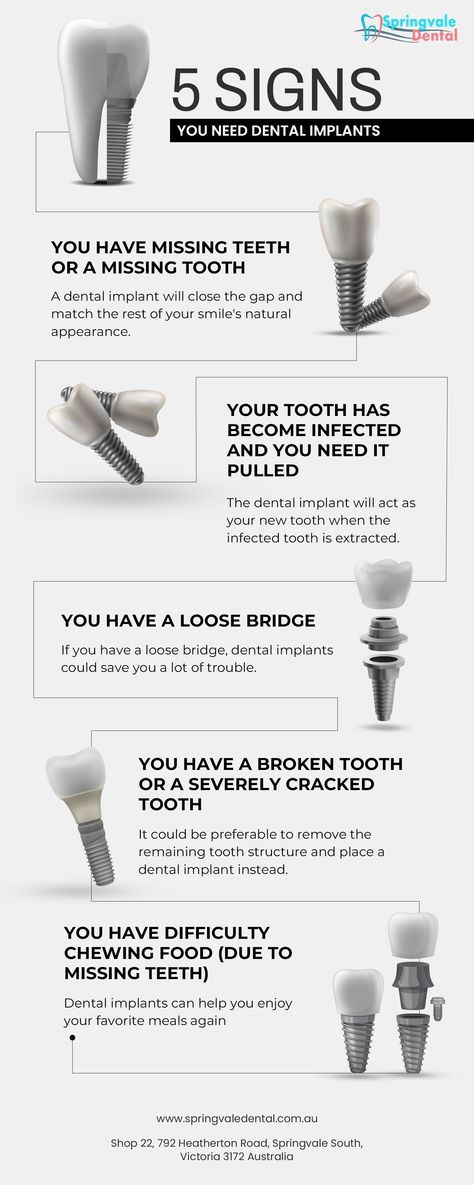 Dental Implant Poster, Dental Post Ideas, Dental Infographics, Dental Post, Dental Poster, Smile Book, Dental Advertising, Dental Social Media, Dental Posts