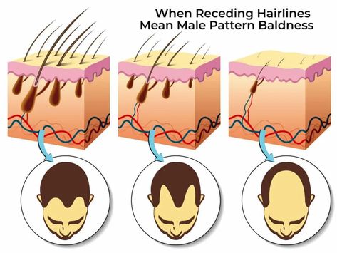 Receding hairline treatments focus on stopping hair loss and regrowing hair along the top of the forehead. It’s best to determine whether you have a mature hairline or a receding hairline due to male pattern hair loss before starting any treatments. There are many treatments and ways to fix a receding hairline. If you catch hair loss early, you may be able to use one of these treatments to stop baldness in its tracks. Androgenic Alopecia, Fue Hair Transplant, Pattern Hair, Male Pattern Baldness, Pattern Baldness, Regrow Hair, Grow Hair Faster, Lost Hair, Hair Restoration