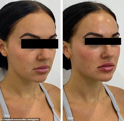 Australian cosmetic doctor reveals the top 10 beauty trends for 2021 | Daily Mail Online Cheek Injections, 1ml Lip Filler, Face Plastic Surgery, Liquid Facelift, Lips Inspiration, Face Fillers, Botox Face, Cheek Fillers, Fat Grafting