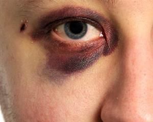 Injury Makeup, Droopy Eyelids, Makeup Class, Fx Makeup, Stage Makeup, Sfx Makeup, Zombie Halloween, Anatomy Reference, Special Effects