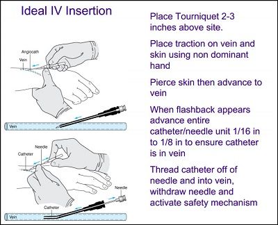 35 IV Therapy Tips & Tricks for Nurses | NurseBuff Inserting Iv Tips, Nursing Iv Insertion, Iv Start, Nursing Iv, Iv Insertion, Iv Administration, Iv Line, Nurse Teaching, Nursing Fun