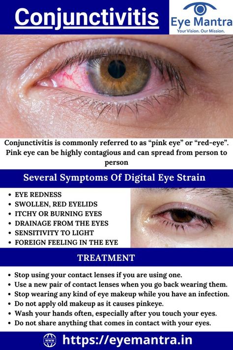 What is conjunctivitis | conjunctivitis treatment | conjunctivitis in the eye removal | conjunctivitis home remedies | all about conjunctivitis | what causes conjunctivitis | conjunctivitis coronavirus symptoms | what is the medical term meaning pinkeye | conjunctivitis, allergic | eye allergic | conjunctivitis treatment | conjunctivitis eye | conjunctivitis eye drops Red Eyes Remedy, Swollen Eyelid, Pinkeye Remedies, Different Types Of Eyes, Strained Eyes, Eye Facts, Nursing School Studying, Old Makeup, Guru Pics