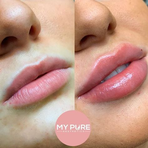 @lipfillerscollective posted to Instagram: 📍 West & South West London ✖ My Pure Aesthetics 👩🏼‍⚕️ Nurse ⁣📷 @mypureaesthetics ⁣⁣⁣⁣⁣⁣#lips #dermalfiller #filler #lipfillers #pout #Kiss #cosmeticinjectables #cosmetic #lipinjections #cosmeticdoctor #perfectlips #lipsonpoint #lipenhancement #lipsoftheday #biglips #lipstick #redlips #cosmeticnurse #cosmeticdoctor #lipsonfleek #lipsonpoint #kyliejennerlips #kylielips #lipliner #biglips #lipinjections #lip Fil Aesthetics Nurse, Dermal Fillers Lips, Pure Aesthetic, Lips Inspiration, Permanente Make-up, Botox Lips, Facial Fillers, Cosmetic Injectables, Facial Contouring