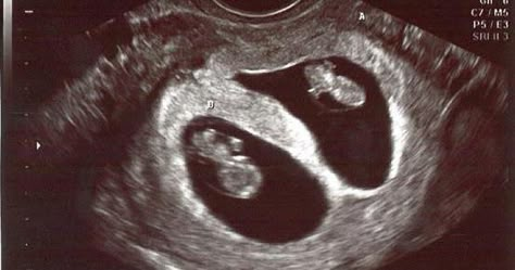 Twins Ultrasound, Twin Belly, Twin Pregnancy Belly, Baby Ultrasound Pictures, 4d Ultrasound, Belly Pics, Baby Ultrasound, Twin Baby Boys