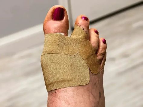 Hammertoe Surgery- What To Expect Improve Mobility, Surgery Recovery, Surgery, Need To Know, Health And Beauty