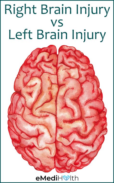 Brain Bleed Recovery, Lesions On Brain, Brain Surgery Humor, L Tyrosine Benefits, My Beautiful Broken Brain, Vitamin Sources, Brain Recovery, Brain Surgery Recovery, Traumatic Brain Injuries