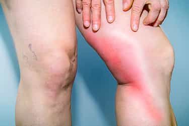 Leg Pain Relief Remedies, Leg Muscle Pain, Lower Leg Pain, Interesting Health Facts, Knee Pain Remedy, Sore Legs, Achy Legs, Swollen Knee, Leg Veins