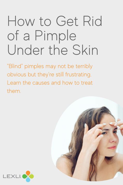 Graphic shows a woman trying to pop a pimple and the headline, "How to Get Rid of a Pimple Under the Skin." Painful Pimple Under Skin, Painful Pimple, Painful Acne, Pimple Causes, Different Types Of Acne, Blind Pimple, Skin Care Advice, Pimples Under The Skin, Under The Skin