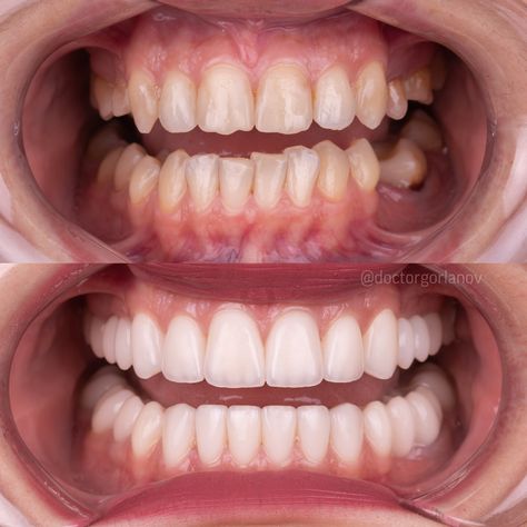 Perfect Natural Teeth, Teeth Before And After, Dental Before And After, Teeth Transformation, Perfect Teeth Smile, Natural Veneers, Kate Richards, Perfect Smile Teeth, Cosmetic Bonding