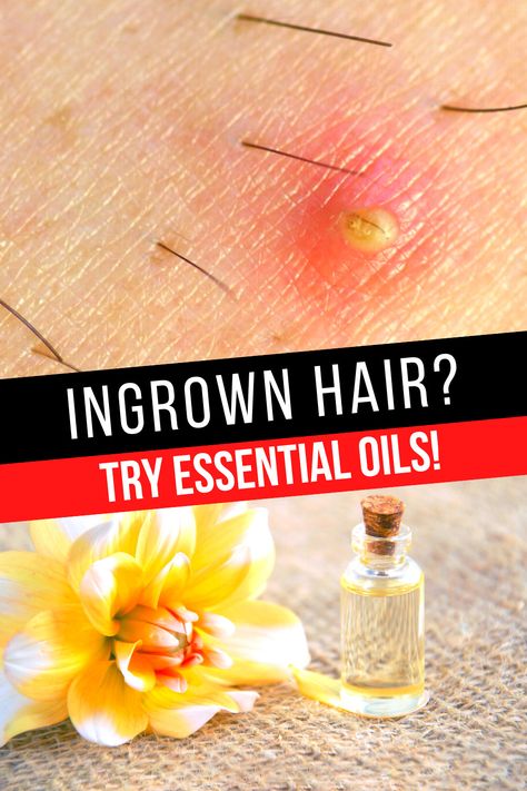 esential oil and ingrown hair Ingrown Hairs, Best Essential Oils, Best Oils, Ingrown Hair, Alternative Medicine, Free Hair, No Time, Essential Oil, The Help