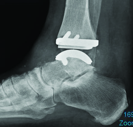 Current And Emerging Insights On Total Ankle Replacement | Podiatry Today