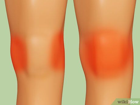 Knee Meniscus, Knee Pain Relief Exercises, Patellofemoral Pain Syndrome, Knee Strength, Joints Pain Remedy, Knee Strengthening Exercises, How To Strengthen Knees, Ways To Heal, Knee Problem