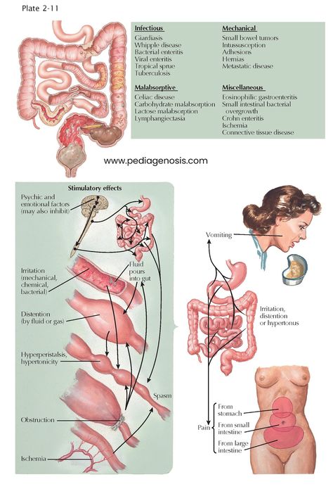 Bile Acid Malabsorption, Superior Mesenteric Artery, Emt Study, Digestion And Absorption, Excessive Gas, Small Intestine Bacterial Overgrowth, Small Intestine, Medical Anatomy, Gluten Sensitivity