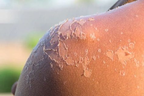 Skin Peeling From Sunburn, Sunburn On Face, Sunburn Face, Sunburn Blisters, Sunburnt Face, Get Rid Of Sunburn, How To Treat Sunburn, Sunburn Peeling, Bad Sunburn