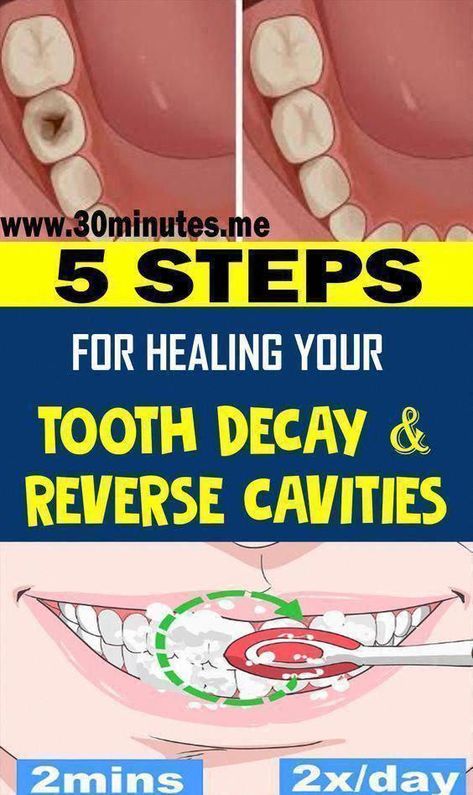 5 Steps For Healing Your Tooth decay And Reverse Cavities – New Healthy Life Now #HowToTakeCareOfOralHealth #WhatIsOralCareSystem #TakeCareOfOralHealth #OralCare #WhyIsOralHealthCareImportant #WhyIsOralCareSoImportant #WhatAreTheOralCareTips #WhatIsTheBestOralCareRoutine #WhatIsThePurposeOfOralCare #WhatIsPrimaryOralHealthCare #WhyIsOralCareImportantInHospitals Reverse Cavities, Dental Cavities, How To Prevent Cavities, Oral Care Routine, Periodontal Disease, Receding Gums, Oral Health Care, Tooth Decay, Oral Hygiene