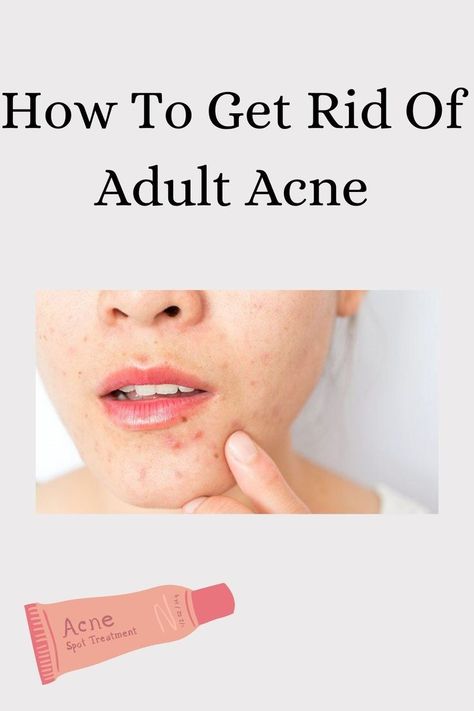 Adult acne is something I personally suffer from and its the worst! To go from a clear face to breaking out all the time🙄 But the good thing is there is always a way to go back from it! Read this article! Break Outs On Face, Face Breaking Out, Skincare For Combination Skin, There Is Always A Way, Blue Light Therapy, Oily Face, Severe Acne, Clear Face, Hormonal Changes