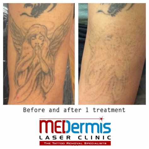 Laser Tattoo Removal Healing, Homemade Tattoos, Laser Skin Care, Tattoo Uk, Web Tattoo, Laser Removal, White Ink Tattoo, Magic Tattoo, Latest Tattoos