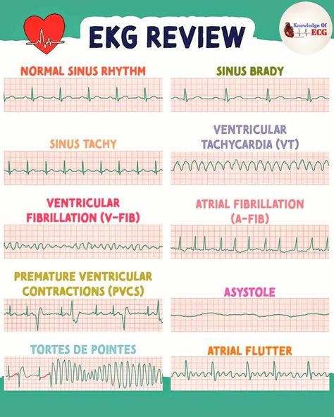 Ekg Nursing, Sinus Rhythm, King Abdulaziz, Nursing Instructor, Normal Sinus Rhythm, Nursing School Essential, Nclex Study, Nursing School Motivation, Nurse Study Notes