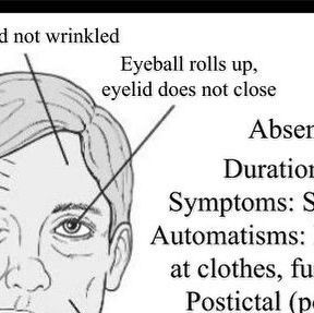 Epilepsy Warrior on Instagram: "Absence seizures can be so quick that you may not see all the symptoms. Some people with absence seizures are even called absent minded by people who don’t understand them. #absenceseizures #seizures #seizetheday #themoreyouknow #epilepsydoesnthaveme" Absent Seizures, Absence Seizures, Absent Minded, The More You Know, Some People, Mindfulness, On Instagram, Instagram