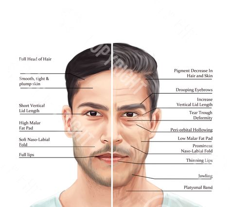 Digital Download Only: No Physical Prints Included Facial Anatomy - Male Ageing of the Face and Neck - Daniel Premium, beautiful, clear and high-quality illustration of Male Ageing of the Face and Neck for digital downloads. It is ideal for use in salons and clinics to create a beautiful framed reference poster & decoration for a professional brand image. Use for student training manuals & teaching resources. High Resolution. 300dpi For ease of use, the download has a transparent background & re Hyper Realistic Drawings, Facial Anatomy, Man Anatomy, Facial Aesthetics, Aesthetic Medicine, For Educational Purposes Only, Poster Decorations, Brand Image, Med Spa