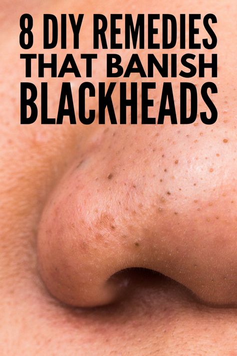 The Best Way to Remove Blackheads: 8 At Home Blackhead Removal Ideas! Hydrogen Peroxide Skin, Remove Blackheads From Nose, Blackhead Remover Diy, Blackhead Remedies, Pimples Under The Skin, To Remove Blackheads, Blackheads On Nose, Rid Of Blackheads, How To Get Rid Of Pimples