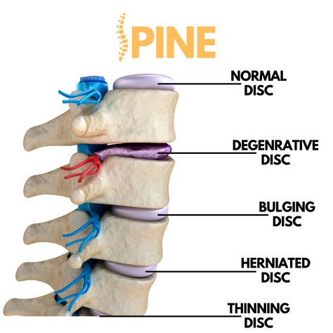 Whomp Whomp, Chiropractic Benefits, Slip Disc, Anatomy Notes, Sciatic Nerve Pain Relief, Disc Herniation, Human Skeleton Anatomy, Basic Anatomy, Cervical Spondylosis