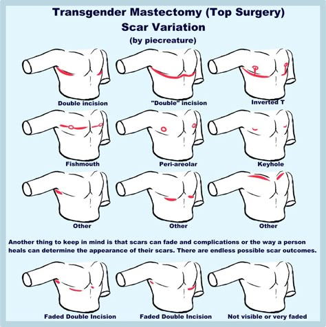 Sylar 🔪 on Twitter: "I usually see people giving their post op trans characters the same "standard" double incision scars. I thought I'd draw up some examples showing that there's tons of different outcomes a person can get from top surgery! They're actually tons of fun to mess around with!!… https://t.co/G1WPgvc7dI" Trans Characters Art, Trans Masc Top Surgery, Trans Dysphoria Drawing, Top Surgery Drawing, Demiboy Art, Trans Drawings Ftm, Trans Top Surgery, Top Surgery Art, Top Surgery Ftm