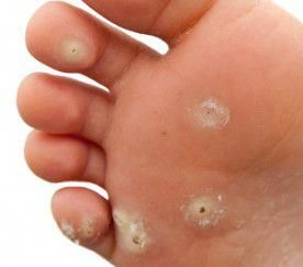 Find out how to get rid of warts, and tips on “wart etiquette” to avoid passing this common condition on to someone else. Planters Wart, Cursed Doodles, Types Of Warts, Warts On Hands, Warts On Face, Home Remedies For Warts, Warts Remedy, Get Rid Of Warts, Natural Cough Remedies