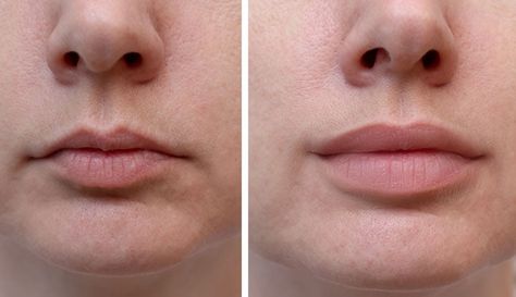 Lip Fillers: What to Expect, Types, Benefits & Side Effects Lip Implants, Juvederm Lips, Hyaluronic Acid Lips, Botox Lips, Hyaluronic Acid Fillers, Lip Trends, Lip Augmentation, Injectables Fillers, Facial Aesthetics