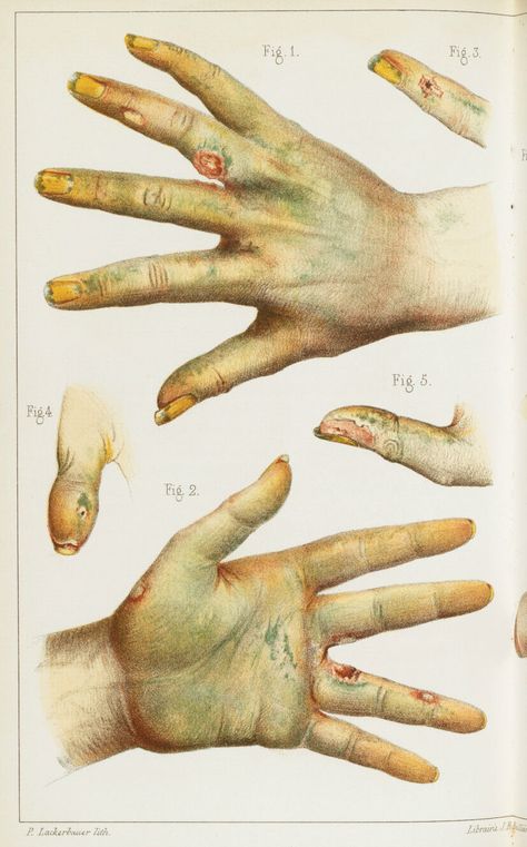 A brief history of poisonous wallpaper Radium Girls, Medical Journal, Medical Journals, Vintage Medical, Human History, Medical Illustration, Fashion Victim, Medical History, Lithography