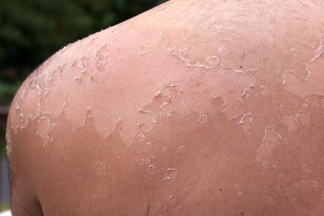 Peeling Sunburned Back. Close up detail of a very bad sunburn showing the peelin , #AD, #bad, #sunburn, #showing, #detail, #Peeling #ad Vinegar For Sunburn, Sunburn Blisters, Get Rid Of Sunburn, Sunburn Peeling, Bad Sunburn, Sunburn Relief, Basal Cell, Peeling Skin, Spray Tanning