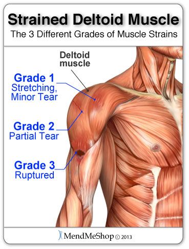 Deltoid Stretches For Pain, Deltoid Muscle, Shoulder Muscle Pain, Shoulder Anatomy, Anatomy Muscles, Muscle Tear, Shoulder Muscle, Rotator Cuff Tear, Leg Muscle