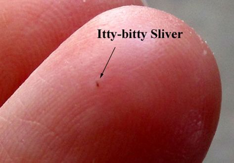 the easiest way to remove a sliver 2 ~The Homesteading Hippy Getting Splinters Out, Sliver Removal, Foot Detox Soak, Splinter Removal, Baking Soda Benefits, Cleaning Advice, Baking Soda Uses, Cleaning Tasks, Household Tips