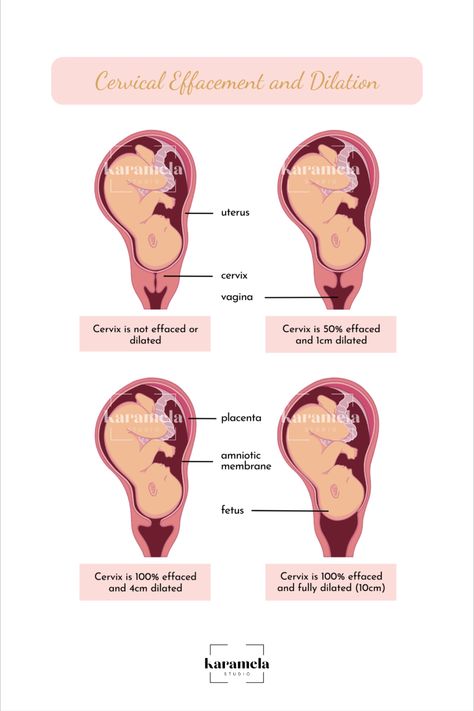 The stretching and thinning of the cervix is called effacement. Cervical effacement is measured in percentage and mostly happens before dilation. The cervix thins and softens at first, and then opens. This happens when labor begins. #DilationAndEffacement #LaborProcesses #CervicalThinning #CervicalEffacement #CervicalDilation #LaborPreparation Cervix Dilation Chart, Cervical Effacement, Dilation And Effacement, Cervix Dilation, Labor Induction, Induction Labor, Medical Office Decor, Induce Labor, Prepare For Labor