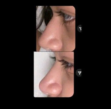 Lips Subliminal Results, Subliminal Results Before And After Face, Nose Subliminal Results, Subliminal Results Nose, Subliminals Results, Subliminals Aesthetic, Ideal Nose, Mermaid Gang, Subliminal Results