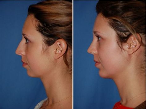 Lipo Before And After, Cheek Implants, Chin Augmentation, Chin Implant, Rhinoplasty Before And After, Nose Shapes, Facial Rejuvenation, Skin Specialist, Facial Plastic