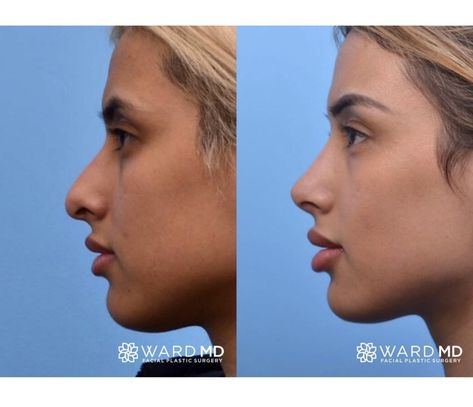 Ward MD Rhinoplasty Before & After ✨ This patient wanted to correct her droopy nasal tip, but did not want a scooped out or hollowed appearance to the bridge or dorsum of the nose. She felt that this gave a more natural look. As you can see we were able to rotate the tip of word while maintaining the natural look of her dorsum. Doesn't she look amazing?! Her nose is much more rounded out and her tip was brought up just a bit to make her nose compliment her facial features. 🥳 Nose Plastic Surgery, Nose Surgery Rhinoplasty, Nose Fillers, Upturned Nose, Bulbous Nose, Nose Types, Nose Jobs, Rhinoplasty Nose Jobs, Face Surgery