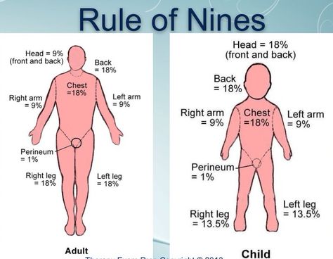 Rule of Nines Rule Of 9 Burns, Rule Of Nines, Emt Study, Associates Degree In Nursing, Nurse Study, Nurse Practitioner School, Nursing School Prerequisites, Nclex Study, Nursing Mnemonics