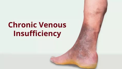 What is Chronic Venous Insufficiency? Home Remedies For Spiders, Leg Ulcers, Leg Veins, Venous Insufficiency, Types Of Surgery, Poor Circulation, Healthy Body Weight, Female Fashion, Fashion Bloggers