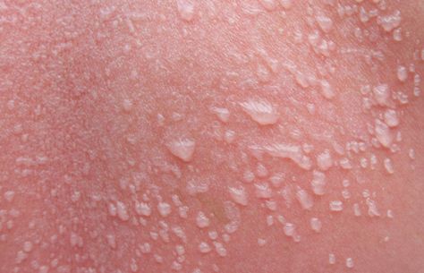 Sun Blisters, How To Treat Blisters, Sunburn Blisters, Blister Remedies, Severe Sunburn, Get Rid Of Sunburn, How To Treat Sunburn, Hangover Headache, Sunburn Peeling